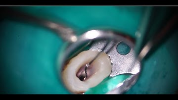 Broken file removal with TFRK-Loop/ループを使った破折器具の除去