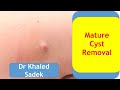 Sebaceous cyst removal. Dr Khaled Sadek. London Cyst Clinic