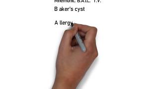 Perimaleolar bilateral edema