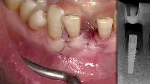 Thommen Implant System Element PF 3.0, Case of Dr....