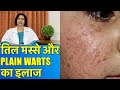 तिल मस्से और Plain Warts का इलाज || Til, Blemishes &amp; Plain Warts Treatment