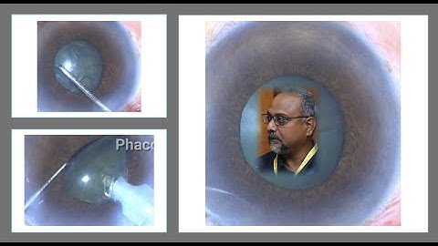 Small Pupil Phacoemulsification -  Rules for Safe and Reproducible surgery .