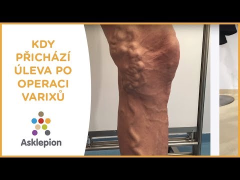 Video: Kdy cvičit po laparotomické operaci?