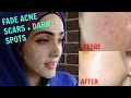 How To Get Rid of Acne Scars & Hyperpigmentation NATURALLY AT HOME| Tx for ALL Skin Types! ~ Immy