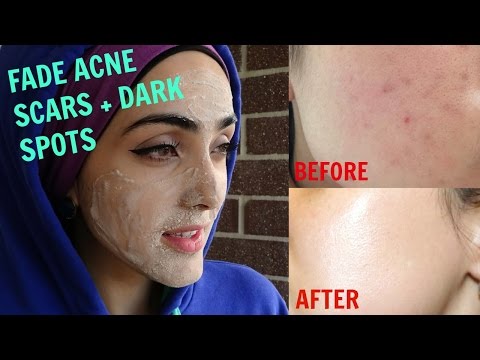 How To Get Rid of Acne Scars & Hyperpigmentation NATURALLY AT HOME| Tx for ALL Skin Types! ~ Immy