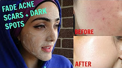 How To Get Rid of Acne Scars & Hyperpigmentation NATURALLY AT HOME| Tx for DRY, NORMAL & OILY Skin!