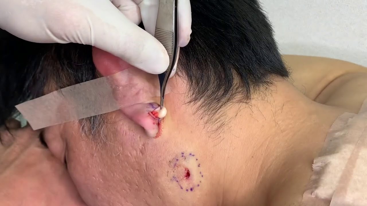 粉瘤くりぬき法　30代男性耳たぶepidermal cyst atheroma cystic acne extractions lipoma大阪心斎橋　大阪梅田院　名古屋　福岡院　神戸西宮　尼崎　奈良