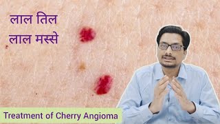       Red Moles  Cherry Angioma  Lal Til Ka Hona  Lal Til Ko Kaise Hataye