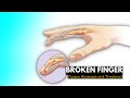 Broken finger, Causes, Signs and Symptoms, Diagnosis and Treatment.