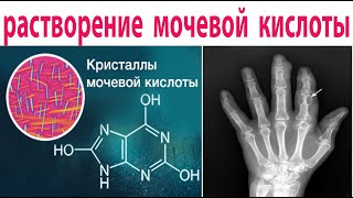 Все Врачи знают это лекарство, снижает уровень мочевой кислоты и лечит подагру.