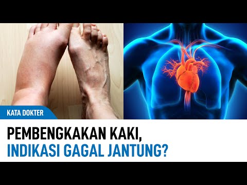 Video: Bolehkah edema menyebabkan kaki merah?