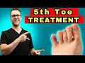 What To Do For A Broken Pinky Toe [How To Tape & Little Toe Treatment]