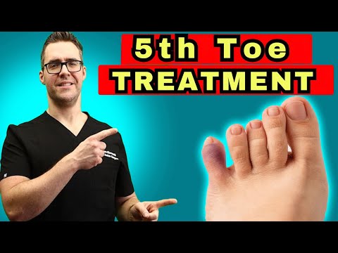 Video: How To Distinguish A Bruised Little Toe From A Fracture: Doctor's Advice