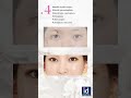 Best 5 Double Eyelid Surgery at ID Hospital