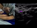 Seeing the structures but missing the needle tip? Try fanning the probe! Changing the...