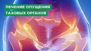 Узнайте правду о гинекологии: эффективное лечение опущения тазовых органов