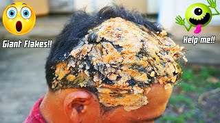 Itchy psoriasis scalp | Huge dandruff flakes Removal in My Brother's Hair #262