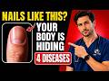 Neurologist Warns: If Your NAILS Look Like THIS After 60, Your Body Can be Hiding 4 Diseases