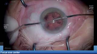 Highly myopic eye , reversed pupillary block Lukan Mishev Live Stream