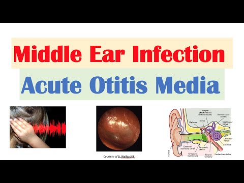 Video: Acute Otitis Media: Oorzaken, Symptomen En Diagnose