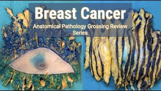 Breast Cancer | Anatomical Pathology Grossing Review Series