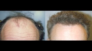 Neograft | Watch the Procedure with Before and After Photos #neograft #hairtransplant