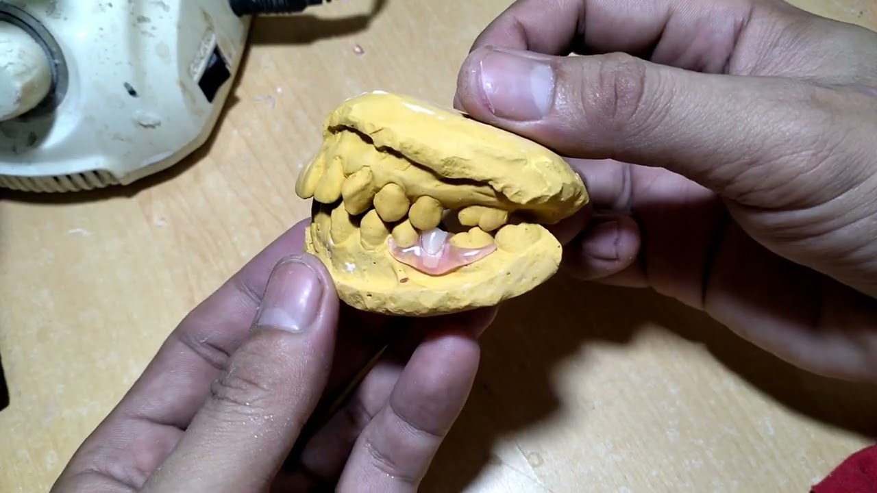 Unilateral flexible dentures YouTube