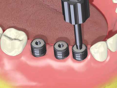 ADIN Implant - 3 implanty - chirurgia i protetyka (animacja) - www.adin-implants.pl