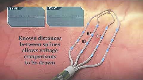 AdvisorHD Grid Mapping Catheter