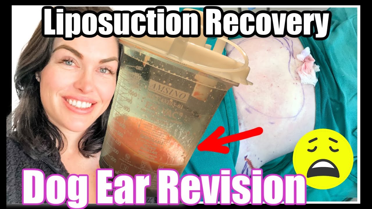 I GOT LIPOSUCTION LIPO POST OP DAY 1 MOMMY MAKEOVER REVISION W/DOG