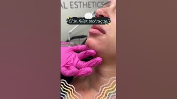 Chin Filler Technique!