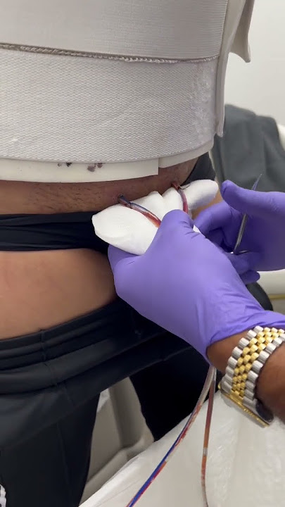 How to remove drains after a tummy tuck! #plasticsurgeon #shorts #tummytucksurgery