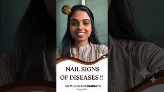 നഖം പെട്ടന്ന് പൊട്ടിപ്പോവാറുണ്ടോ|Nail Signs healthtips nails healthcare shorts