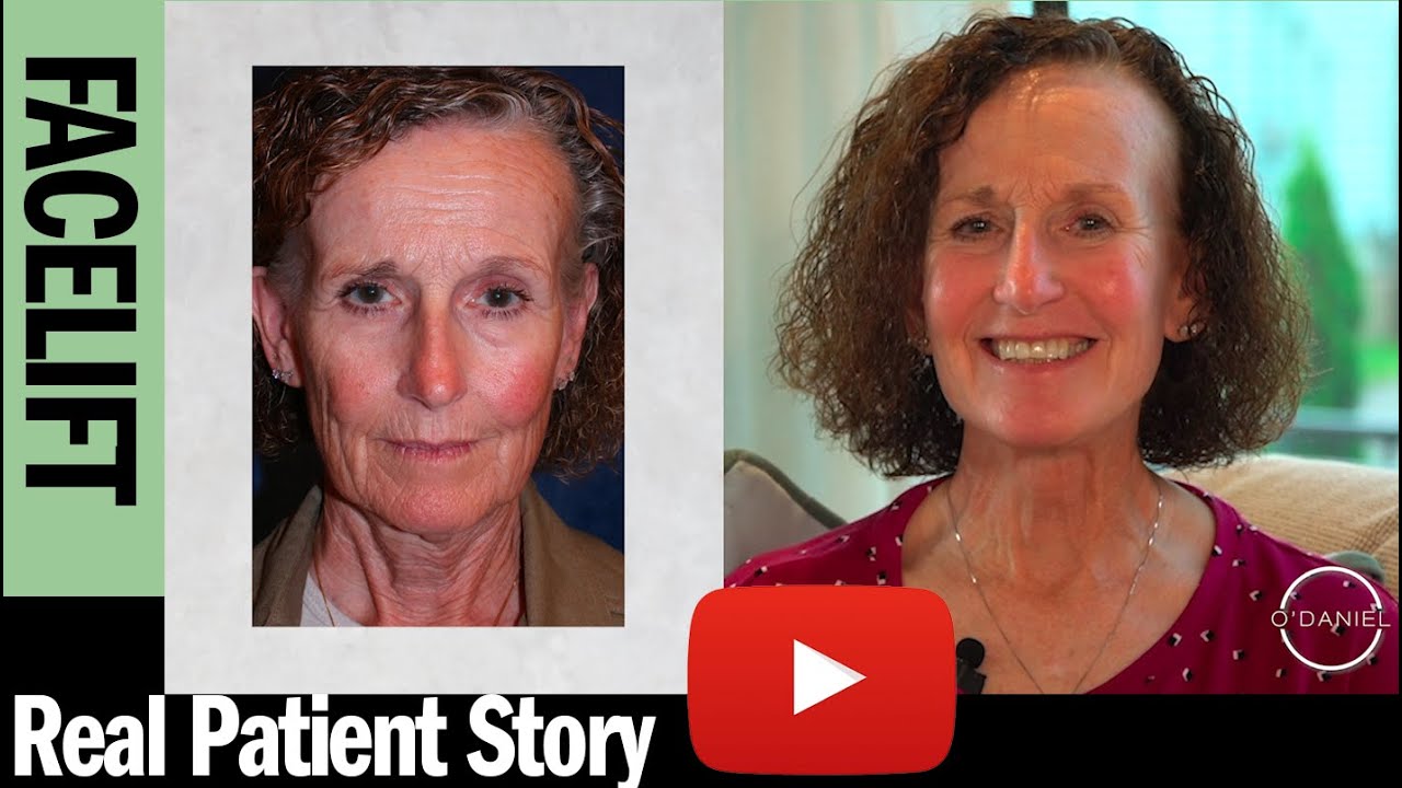 Real patient facelift results