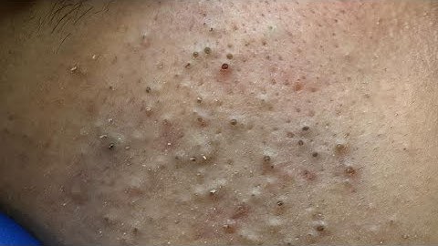 [ASMR] Deep Cleansing Techniques for Acne-Prone Skin and Blackheads