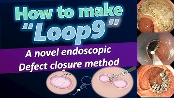 How to make Loop9  -Novel endoscopic defect closure method-