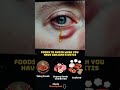 Top 9 Foods to Avoid with Keratitis