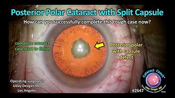 CataractCoach™ 2647: posterieure polaire cataract met gespleten kapsel