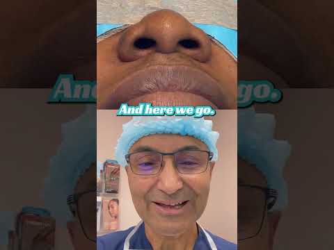 Lovely Patient From Haiti Can T Believe Her New Nose