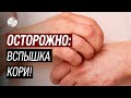 В мире растёт число больных корью. Что необходимо предпринять?