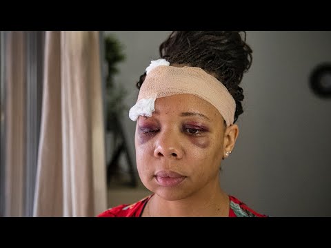 Police fracture protester's eye socket with projectile during George Floyd protest in Florida