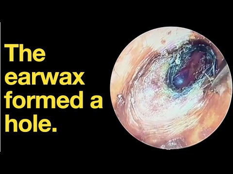 The earwax formed a hole. |ear wax removal | ear cleaning | ASMR ...