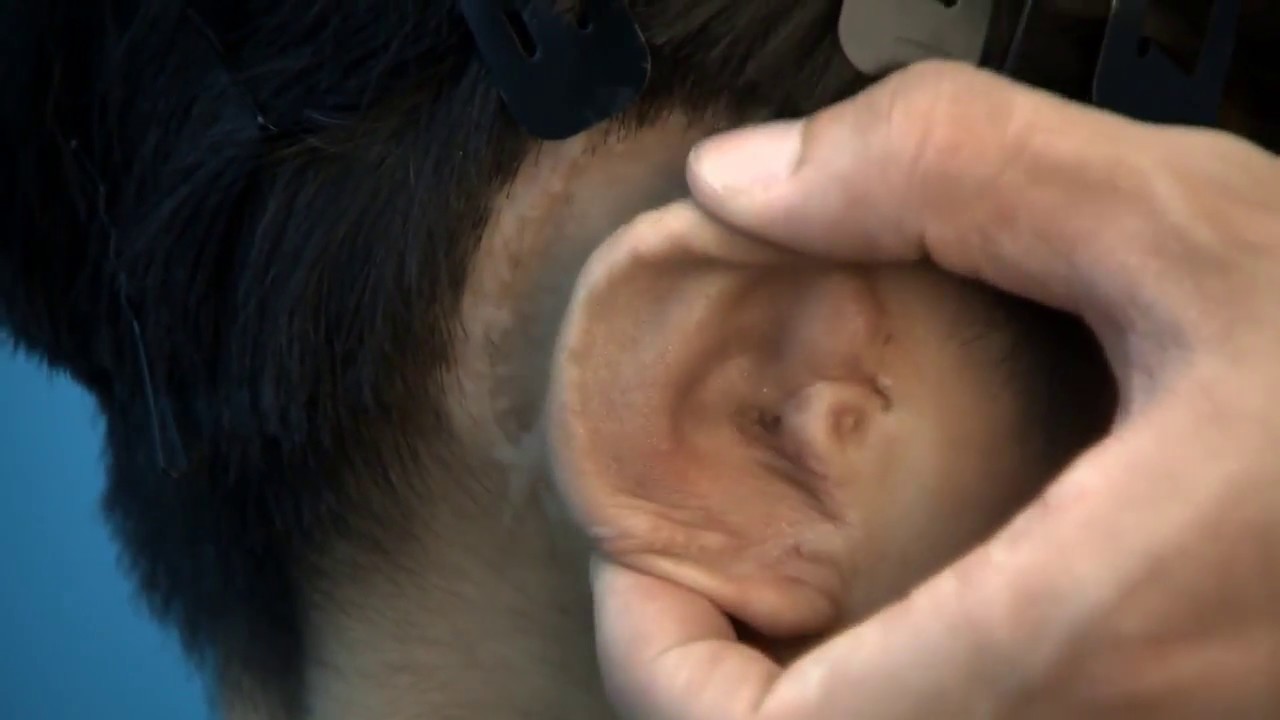 Grown inside 3D-printed molds: new ears for children