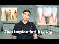 TISH IMPLANTLARI HAQIDA/ ТИШ ИМПЛАНТЛАРИ ХАКИДА