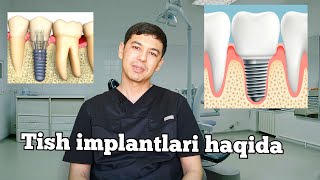 TISH IMPLANTLARI HAQIDA/ ТИШ ИМПЛАНТЛАРИ ХАКИДА