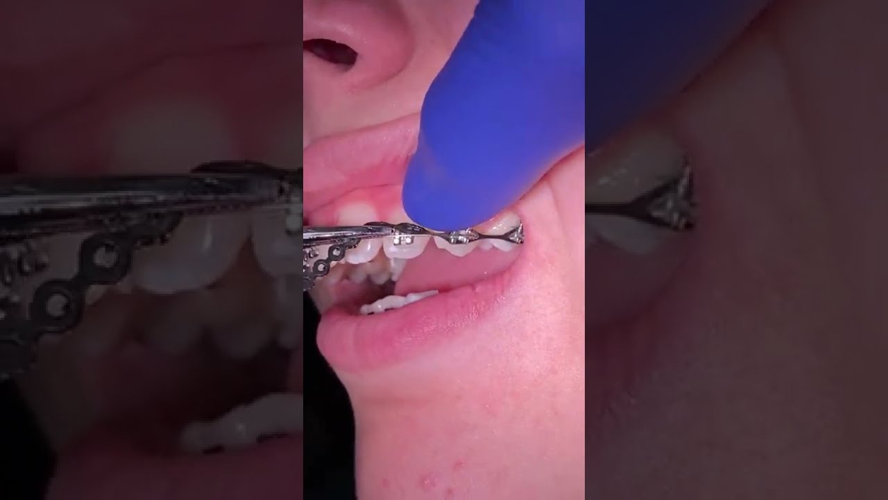 Orthodontic power chain - Tooth Time Family Dentistry New Braunfels - Dentist