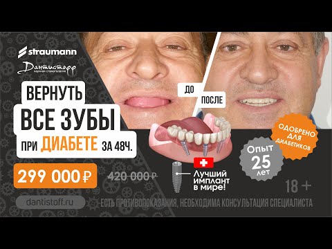 Имплантация зубов до/после😍. +7 (495) 255-59-37 Сахарный диабет не приговор! Straumann ProArch