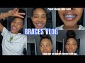 VLOG | Come get my braces tightened with me! + Power chains + new color..Pain level?