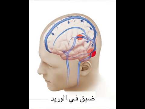اهم سبب لطنين الاذن النابض الطنين الوريدي د مصطفى فريد