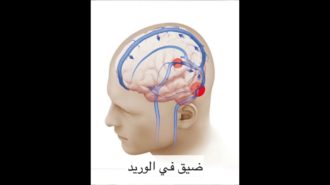 اهم سبب لطنين الاذن النابض : الطنين الوريدي | د. مصطفى فريد